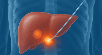 Brachytherapy liver metastases